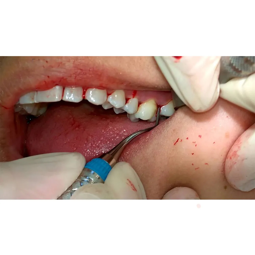 GDC Gracey Curette CC Premolars,Molars,Facial,Lingual Surfaces #7 (Sgcc7/8)