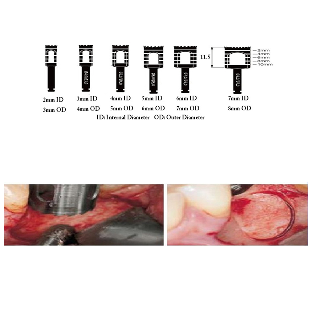 Julldent Trephine Drills Refills