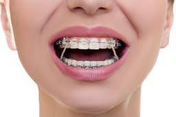 Penta Ortho Intraoral Elastics - Light & Medium (Pack of 1000) - 9