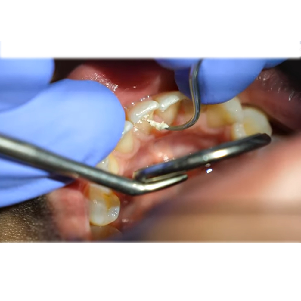 GDC Sickle Scalers Anterior #6 (Sn137)