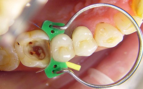 ET Dental Silicone Wedges	