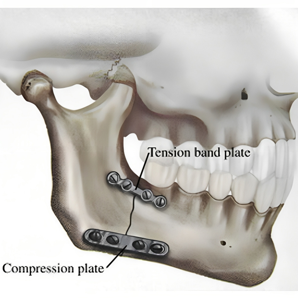 SK Surgicals SS Locking Screws