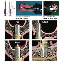 Julldent Crestal Approach Sinus Cas-kit - 4