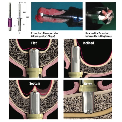 Julldent Crestal Approach Sinus Cas-kit