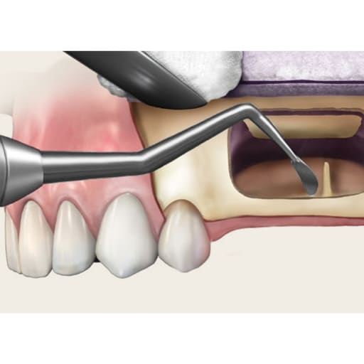 Oracraft Sinus Lifting Instruments - Hollow Handle