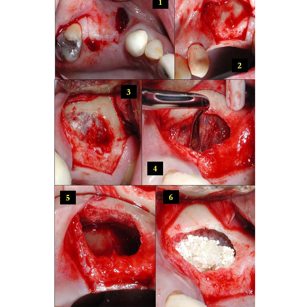 Oracraft Sinus Lifting Instruments - Hollow Handle