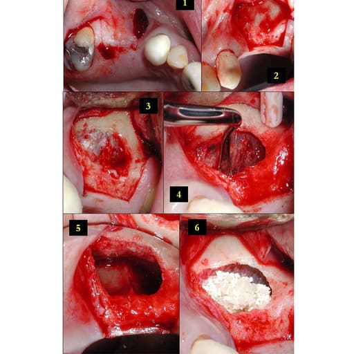 Oracraft Sinus Lifting Instruments - Hollow Handle