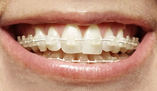 U Ortho SS Tooth Color Wire - Rectangular (Pack of 1)