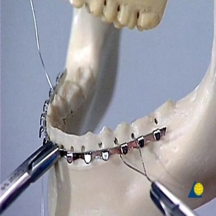 SK Surgicals Arch Bar  (504.001)