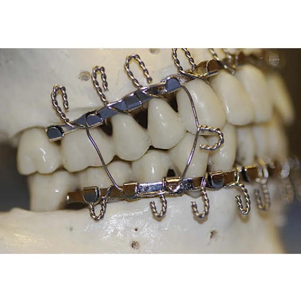 SK Surgicals Arch Bar  (504.001)