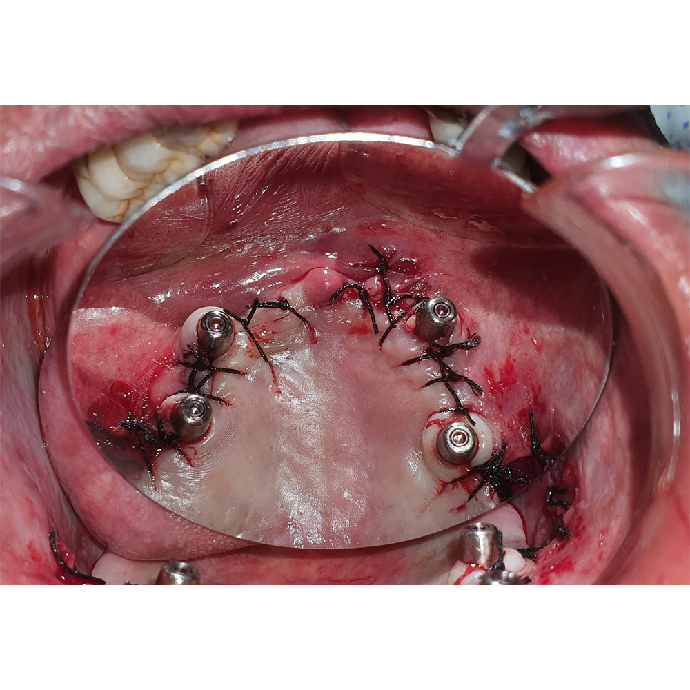 Julldent 115 Smart Mirror For Dental Photography