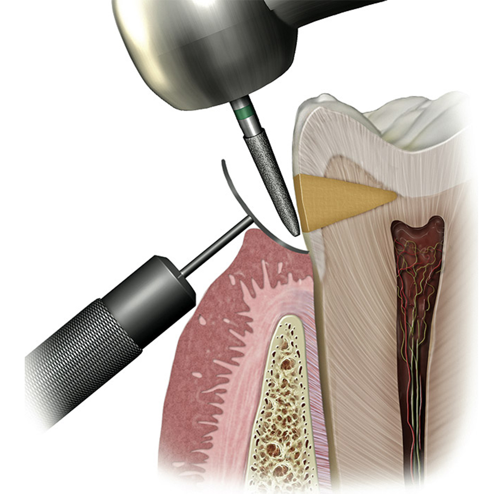 Julldent Socket Shield Retractor/Gingival Protector (Jull-Dent 092)