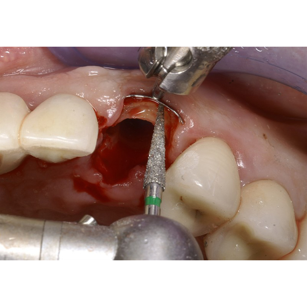 Julldent Socket Shield Retractor/Gingival Protector (Jull-Dent 092)
