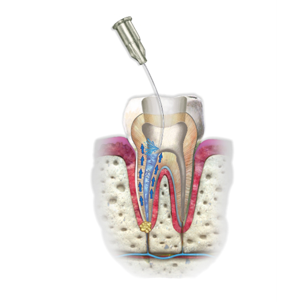 Waldent Sodium Hypochlorite 5% 