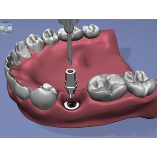 Xcem Dental Implant Submerged Solid Abutment 4mm
