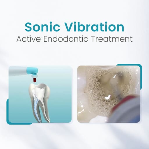 SuperEndo Sonic Flush Endo Irrigator (120 Tips Free)