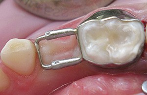 Kids-e-Dental Straight Loops (Pk of 10)