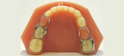 U Ortho 2nd Molar Space Maintainer (10Set/box) - 18