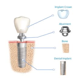 Nextin Spera Conventional Dental Implant With Cover Screw 3.5mm - 6