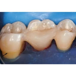 Polydentia Fiber-Splint With Clips - 6