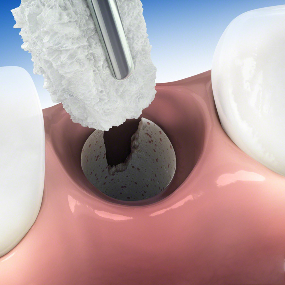 Geistlich Bio-Oss Collagen (Spongious Bone Substitute)