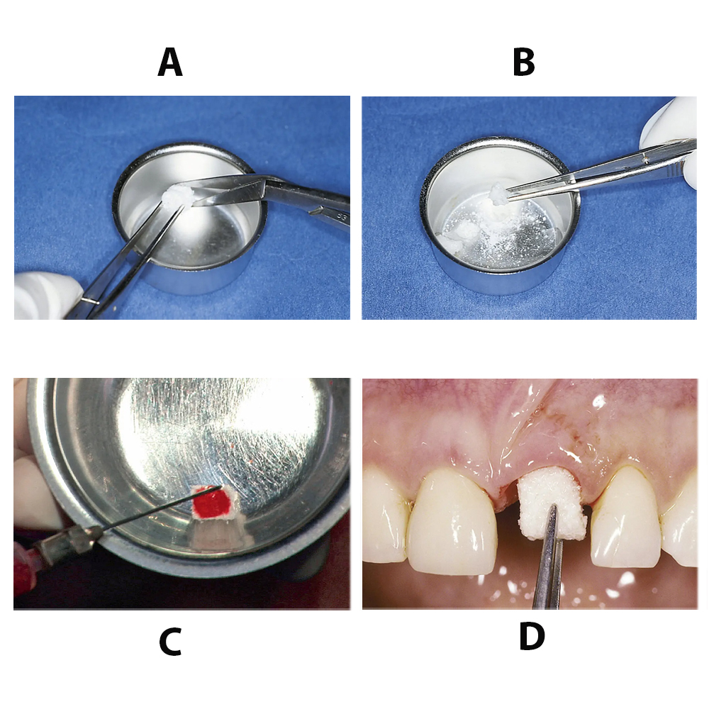 Geistlich Bio-Oss Collagen (Spongious Bone Substitute)
