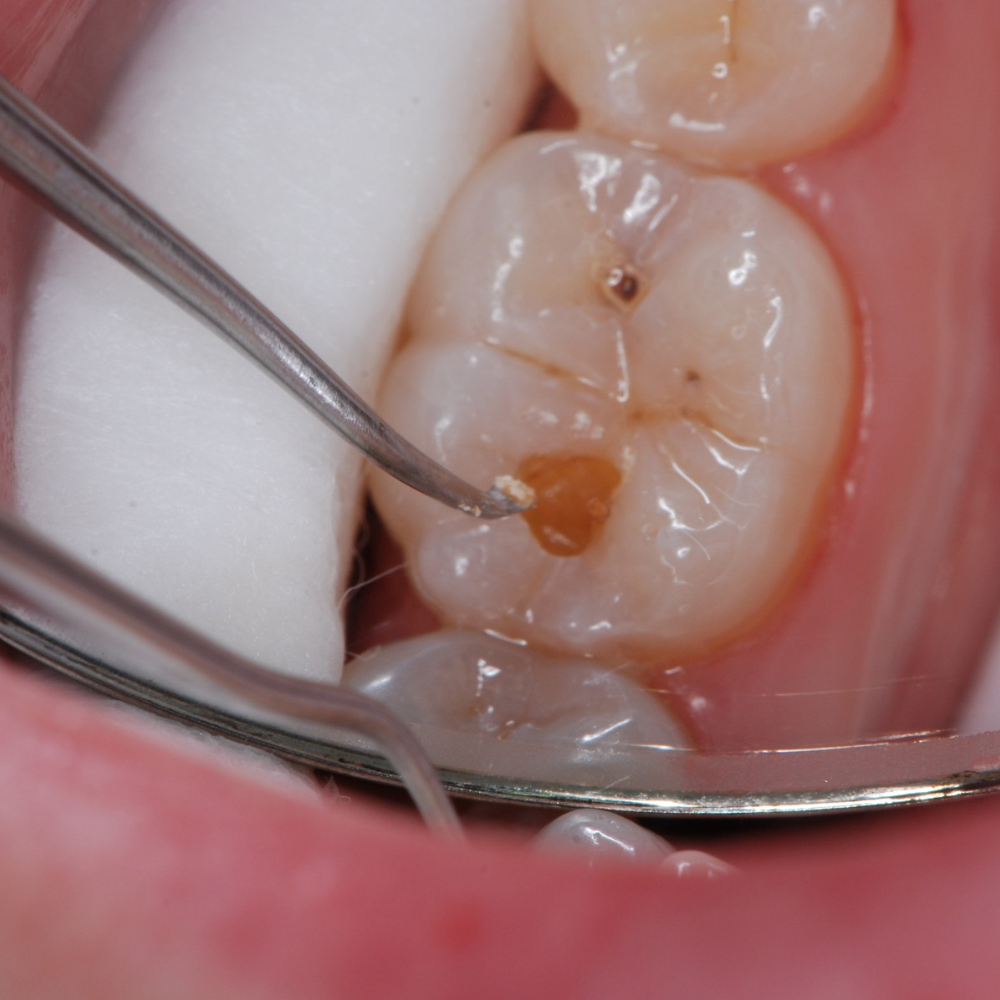 GDC Endo Spoon Excavator-1 EXC33L