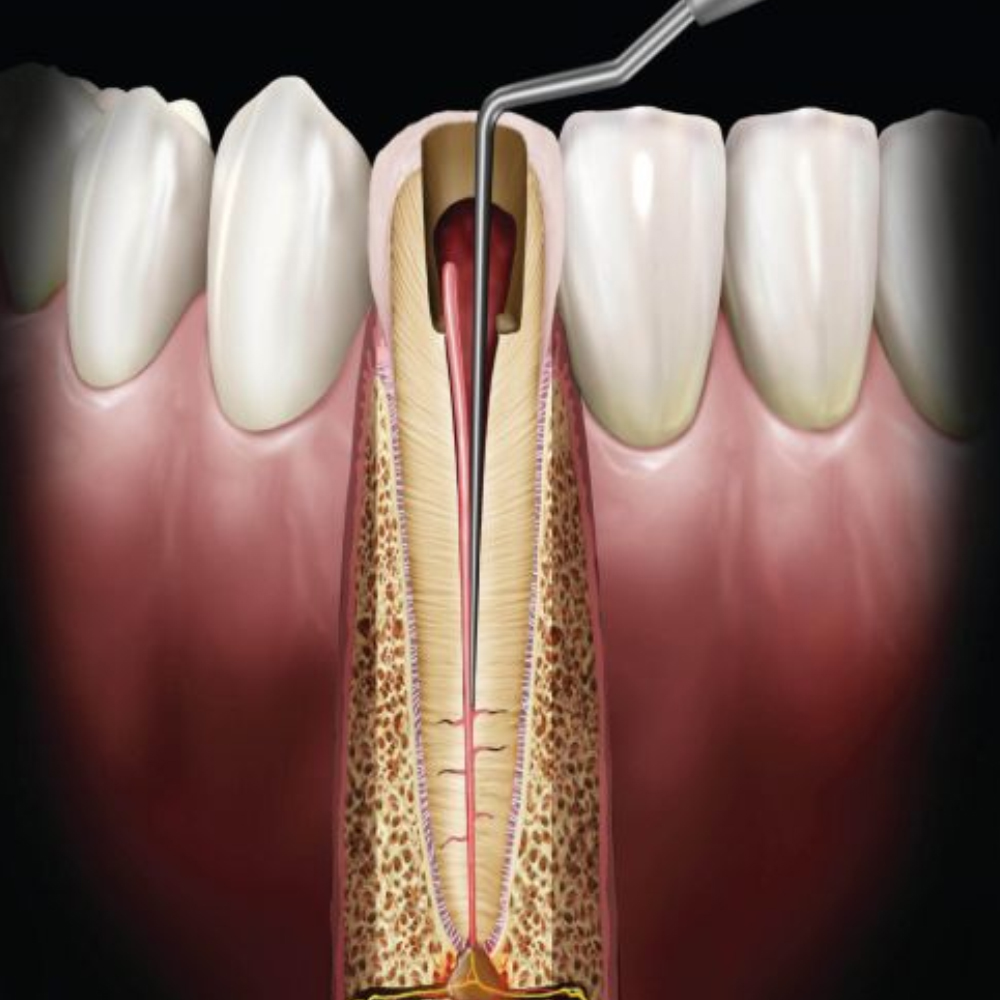 GDC Spreaders -1 (.35mm) (Rcsd11ts)