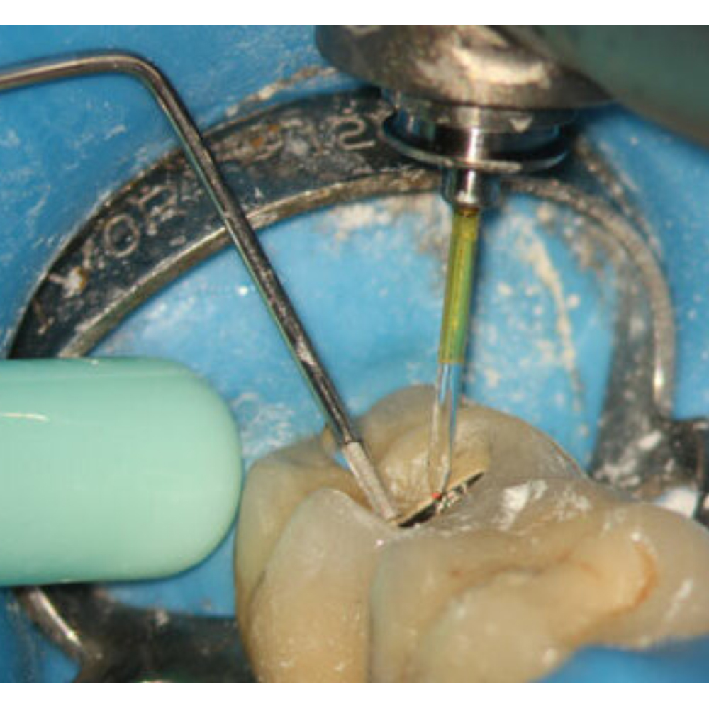 GDC Spreaders -1 (Rcsgp1)