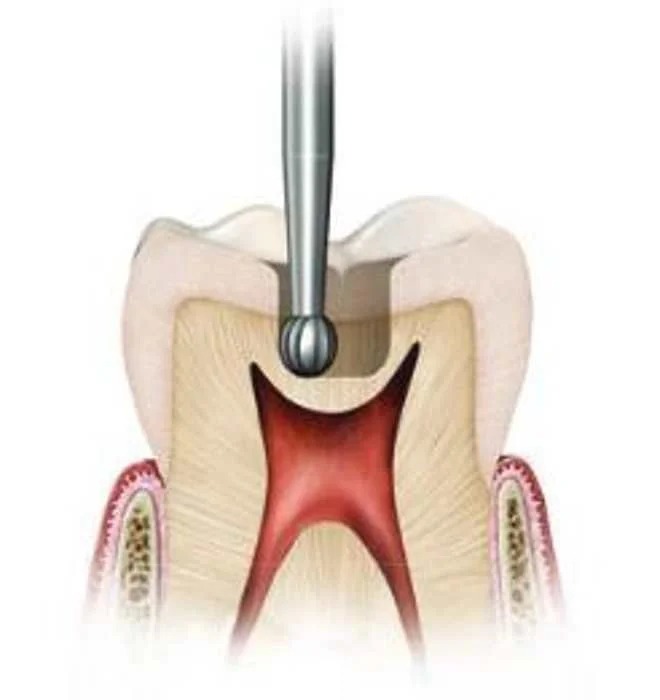 NewDiamond Round Carbide Straight Handpiece Burs (Pack of 5)