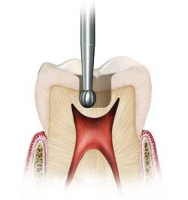 Ss White Surgical Length Carbide Airotor FG Burs