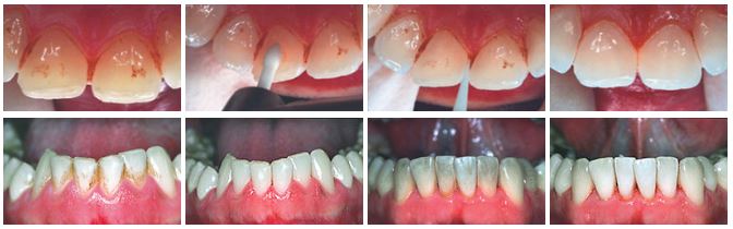 Abrasive Tech Stainbuster Burs For Cement & Stain Removal