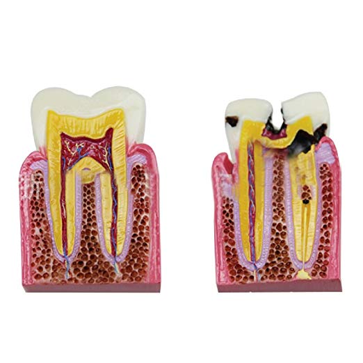 iDENTical Caries V/S Healthy Teeth Model M4021