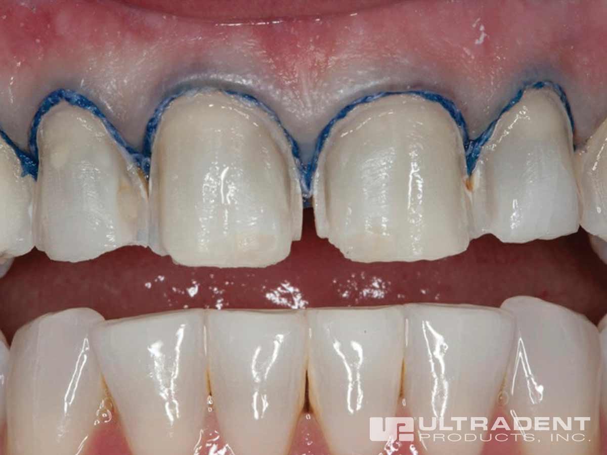 Ultradent Fischer's Ultrapak Packer 