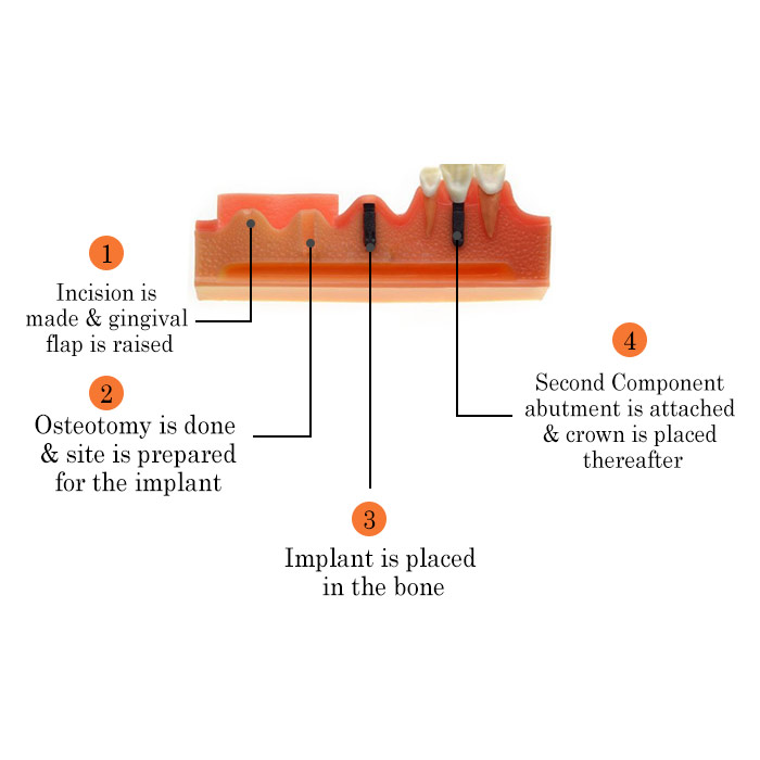 iDENTical Steps for Implant Model M2018