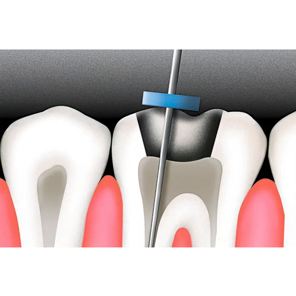 SuperEndo Silicon File Stoppers (Pack of 100)