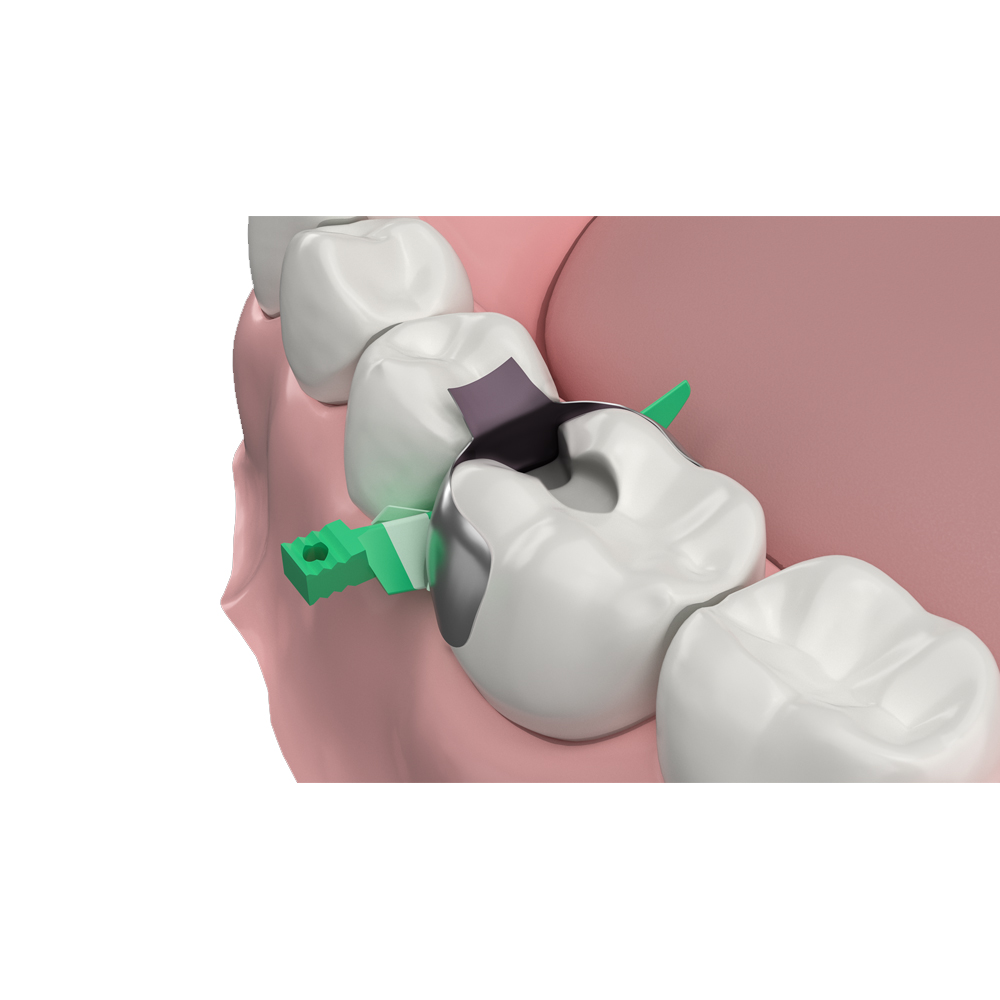 Garrison Dental Strata-G Sectional Matrix Bands