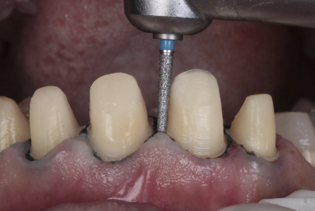 Prima Dental Taper Flat End Bur FG (Pack Of 5 Burs)