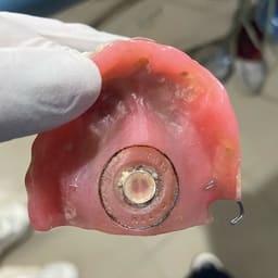 MDM Y - Dents Denture Suction Chamber Discs - 5