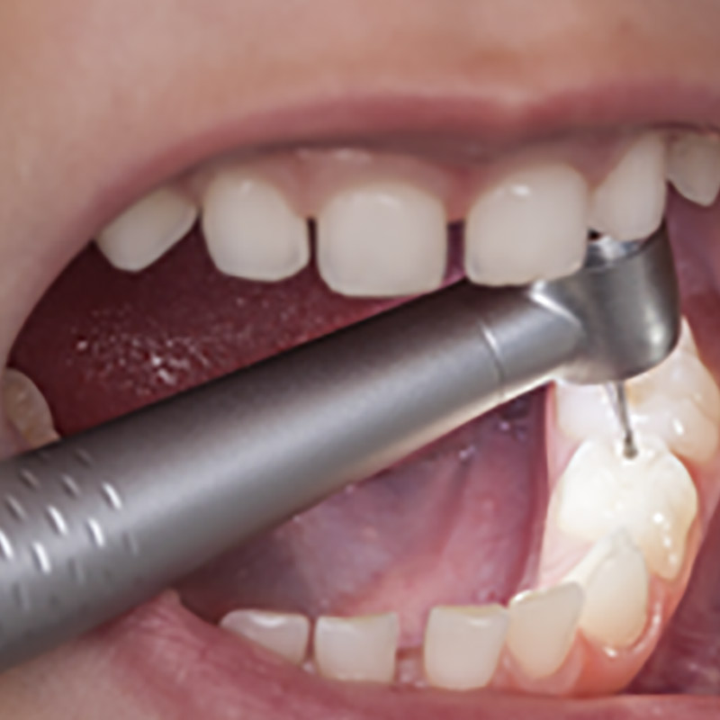 Waldent Sunny Airotor And Cartridge 