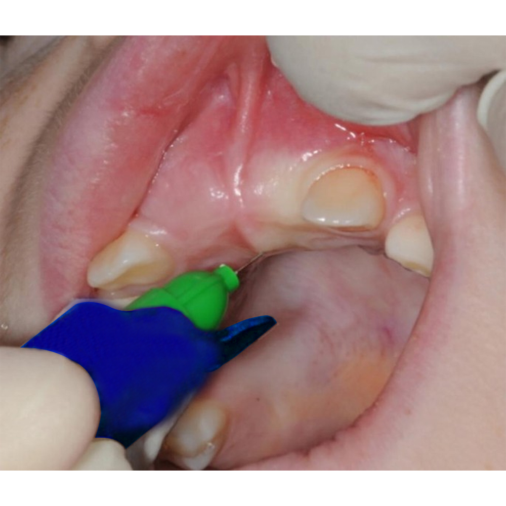 GDC Dental Intraligamental Syringe - Inject (Syri1)