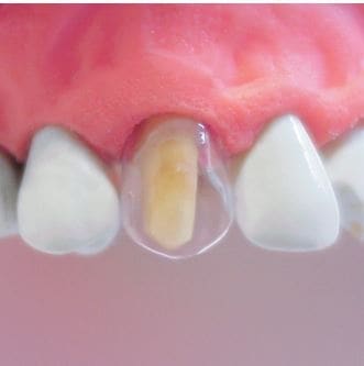 Tor Vm Transparent Crowns 64 pcs - Anterior No. 1.910