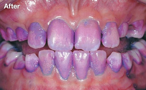 Vishal Dentocare Plak‐Check