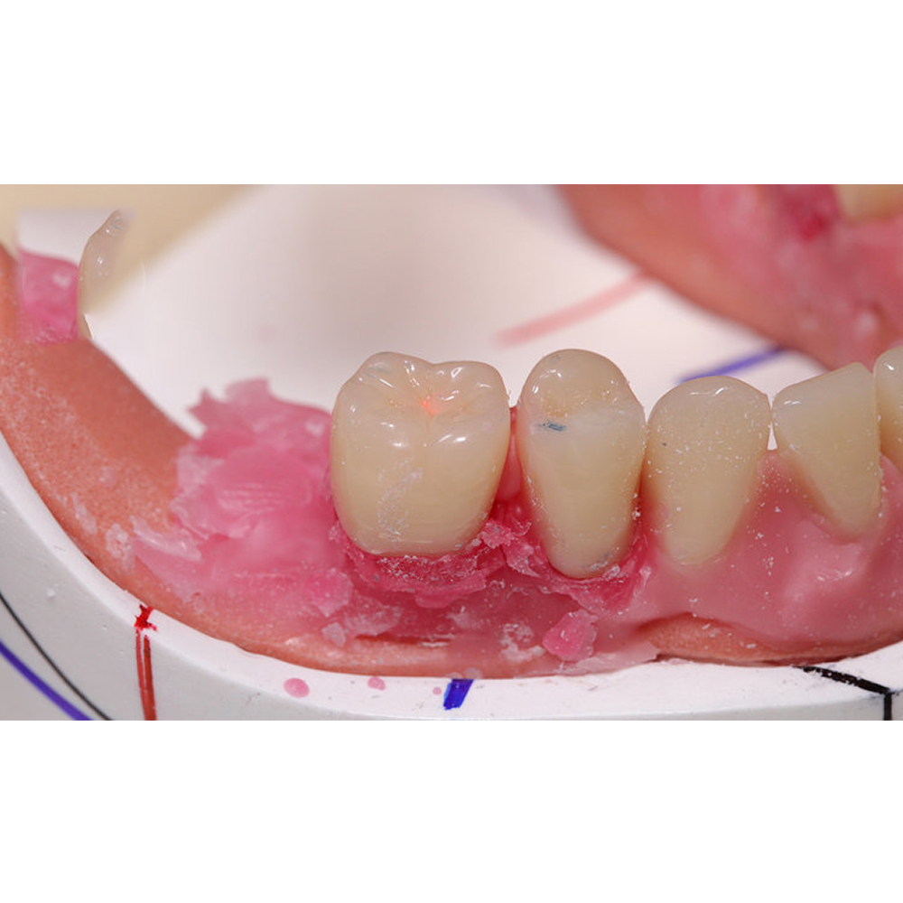 API Acrylic Teeth Sets - NewDent A1 (Pack of 4 Sets)