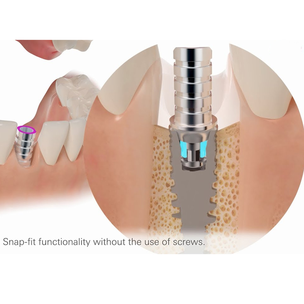 Xcem Conical Temporary Abutment
