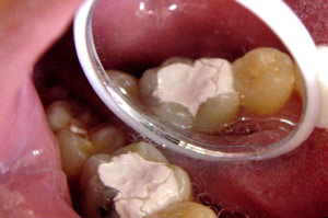 Medicept Stic Temporary Cavity Filling Material