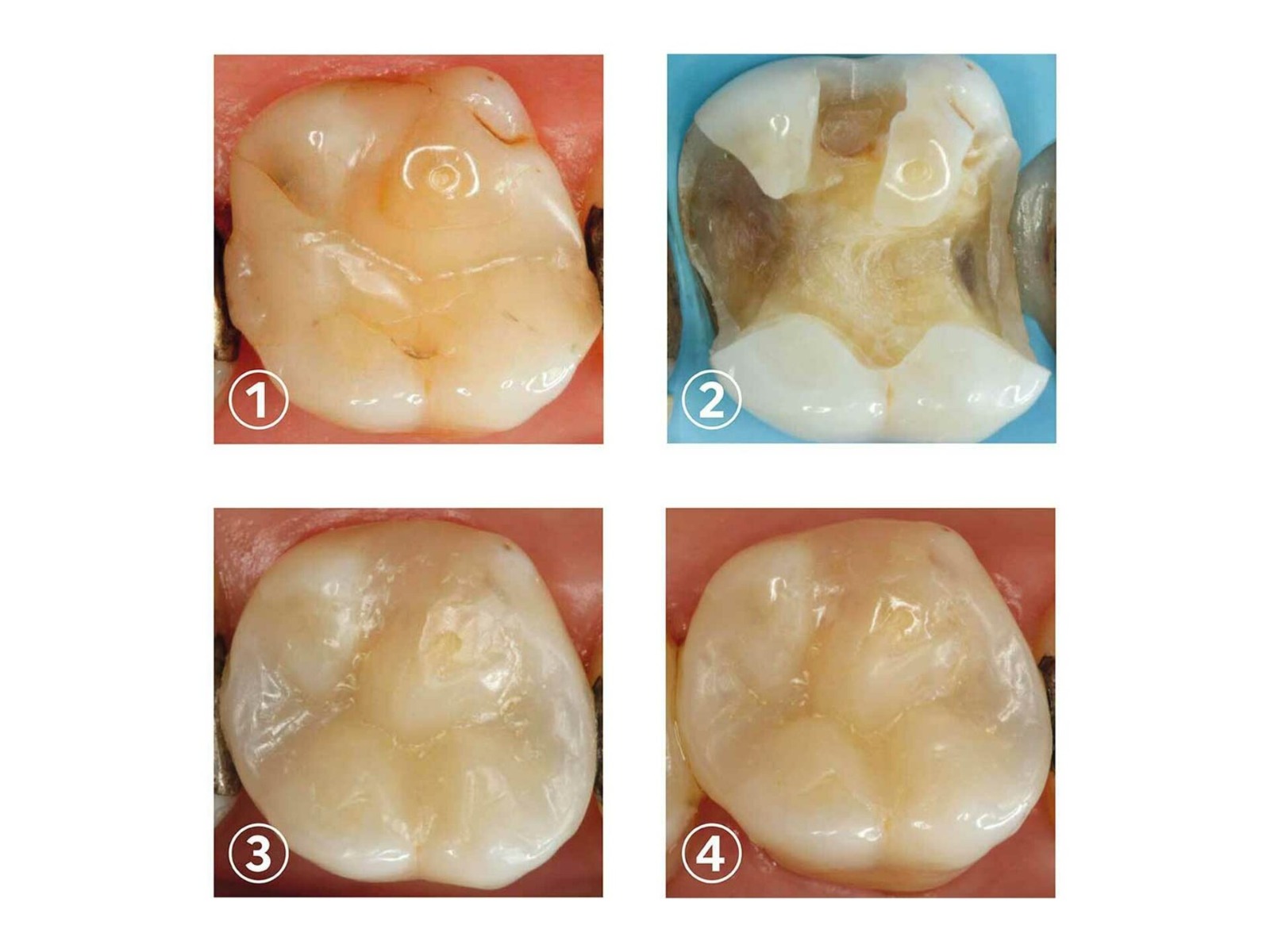 SafeEndo ReCreate LC