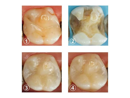 SafeEndo ReCreate LC