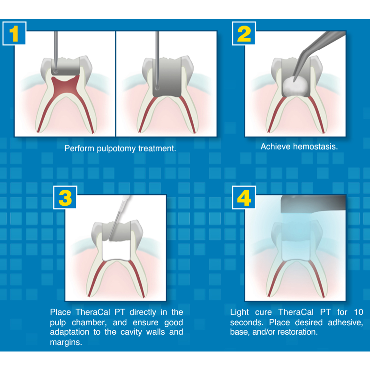 Bisco TheraCal PT DC Resin Modified Calcium Silicate Material