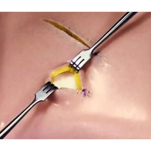 Oracraft Appuntito Tissue Retractor